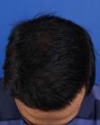After Hair Transplant&nbsp;Front
